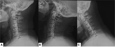 Frontiers The Effect Of K Line Classification In Different Cervical